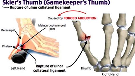 Ucl Ligament - Fpt Disorders Of The Elbow Ligaments Ucl Lucl ...