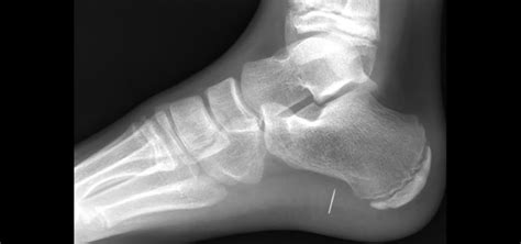 Watch Your Step! Soft tissue foreign bodies in the foot - Cincinnati Children's Blog