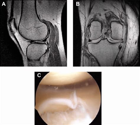 Medial Meniscus