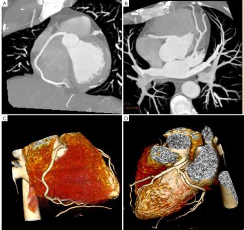 Professional Ct Coronary Angiography Scan And Ct Coronary Artery | My ...