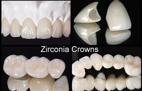 Advantages and Disadvantages of Zirconia Crown | AVF Dental Group