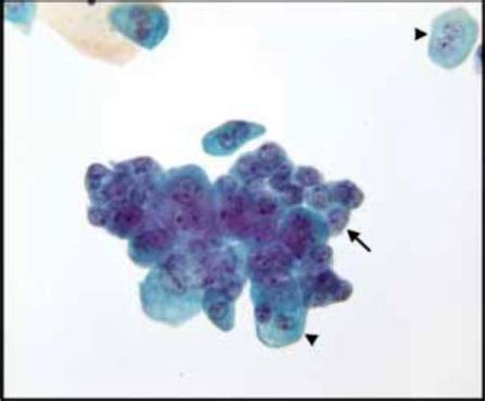 Urine and Bladder Washing Cytology Flashcards | Quizlet