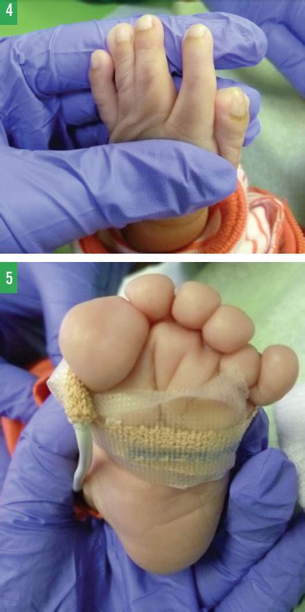 Pfeiffer Syndrome Type 2: Cloverleaf-Shaped Skull in a Newborn | Consultant360