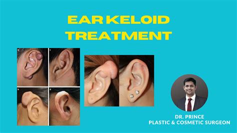 "Incredibly Scary Keloid On Ear piercing! What To Do?" - topplasticsurgery