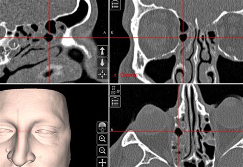 CT scan of a bulla ethmoidalis. This cell sits above the horizontal... | Download Scientific Diagram