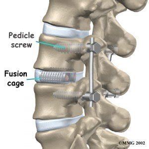 Stabilizzazione vertebrale - Dr. Scrofani Raffaele