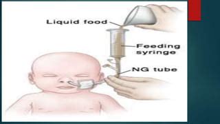 Tube feeding ( Gavage feeding ) | PPT