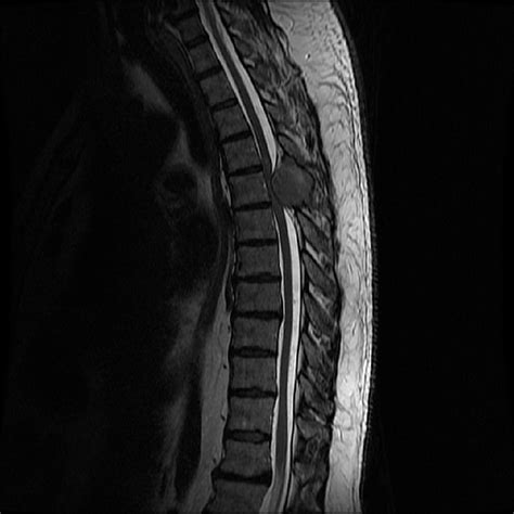 Cureus | Isolated Spinal Metastasis with Spinal Cord Compression Leads ...