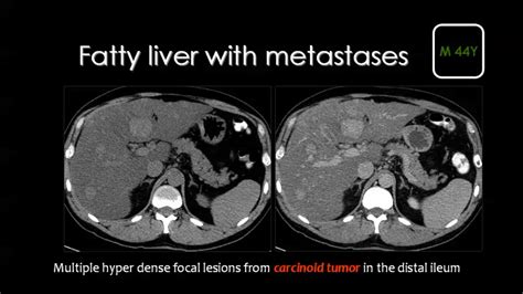 Fatty Liver Ct - Herbs and Food Recipes