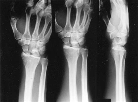 Radial Styloid Fracture