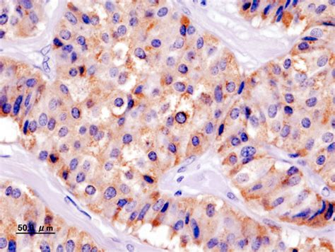 Insulinoma pathophysiology - wikidoc