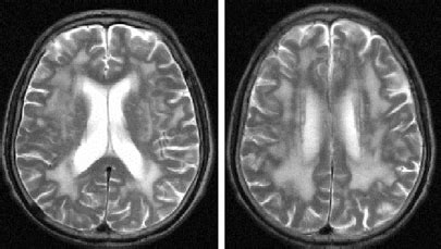 Periventricular white matter hyperintensities in T2 weighted MRI (Source: | Download Scientific ...