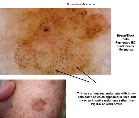 Dermoscopy Made Simple: Melanoma in situ mainly