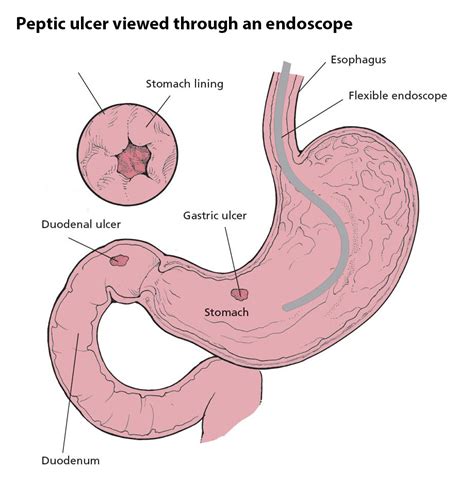 Gastric Ulcer - Healthcare Blog Article By Dr. O