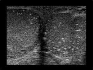 Urinary Tract and male reproductive system | 2.3 Scrotum : Case 2.3.13 Microlithiasis and ...