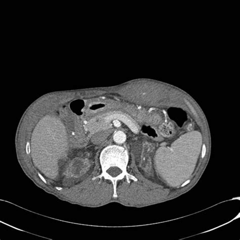 Enhanced computed tomography of abdomen. There is about 8.2 3 3.0 3... | Download Scientific Diagram