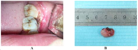 (A) Intraoperative view of the wound after removal of the pregnancy ...