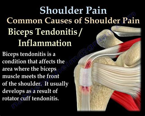 Shoulder Tendons Chart / Inflamed Shoulder Tendons Medlineplus Medical ...