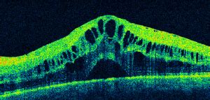 Oct Macula Layers