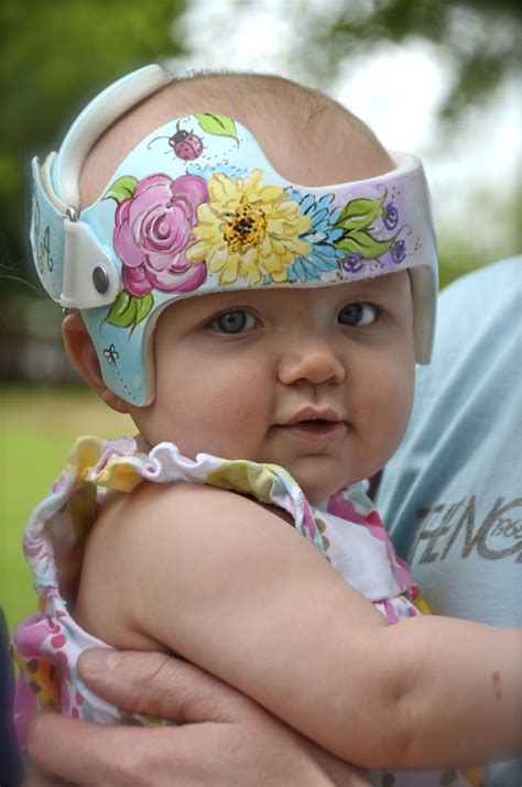 Doc Band Cranial Helmet With Before And After Photos Salty, 56% OFF