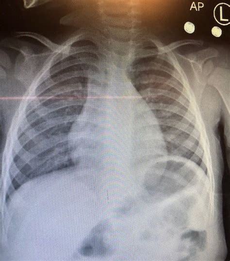 An Unusual Presentation of Human Metapneumovirus Infection | Consultant360