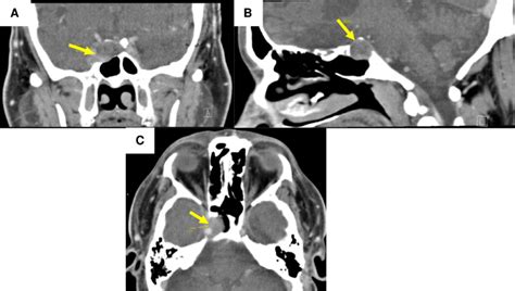 Computed tomography scan of the brain from case 1. Arrows are pointing... | Download Scientific ...