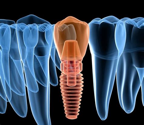 Los beneficios de las Carillas Dentales: una sonrisa perfecta al alcance de todos | Clinica Chela