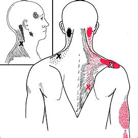 What is Mouse Shoulder? — Crown Wellness Center