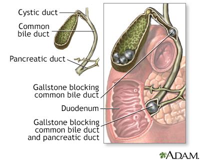 Passing Gallstones