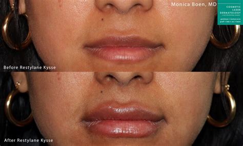 Restylane Kysse Lip Filler MedSpa | San Diego, CA | CLDerm