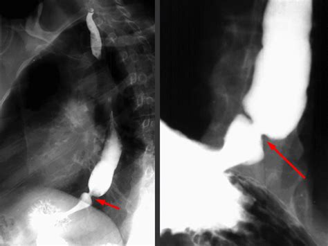 Update 82+ b ring esophagus radiology super hot - vova.edu.vn