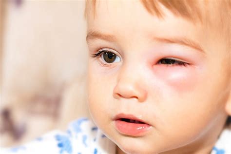 Eye Infections in Baby, Children & Adults - Causes, Diagnosis & Treatment