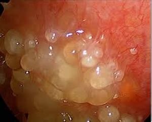 Primary Peritoneal Cancer - Assignment Point