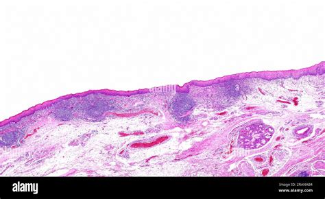 Inflammatory nodules on larynx, light micrograph Stock Photo - Alamy