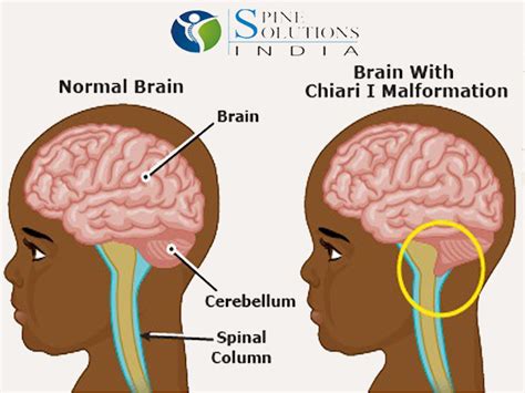 Spine Solutions India by Dr Sudeep Jain: Chiari Malformation: A structural defect in the Cerebellum