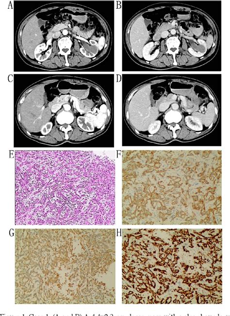 Figure 1 from Mucinous tubular and spindle cell carcinoma of the kidney ...