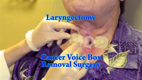 Laryngectomy by Dr Majid Ahmed Talikoti - YouTube