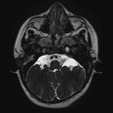 Inner ear malformations (classification) | Radiology Reference Article | Radiopaedia.org