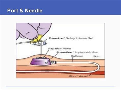 Port needle