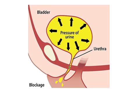 Fantastic Info About How To Prevent Urine Leakage - Partnershipcopy26