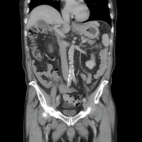 Ct Scan Of Abdomen And Pelvis Cancer