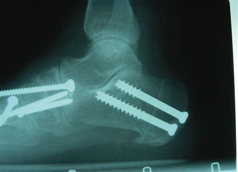 A Closer Look At The Percutaneous Calcaneal Displacement Osteotomy