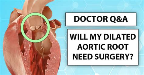 Dilated Aortic Root Progression: What Should Patients Know?