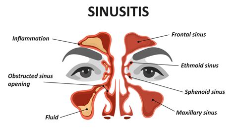 How to Relieve Sinus Pressure in Ears: MDs' Best Tips | Woman's World