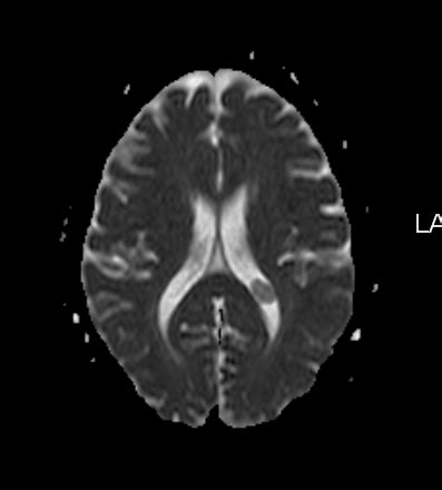 Choroid Plexus Xantogranulomata-MRI - Sumer's Radiology Blog