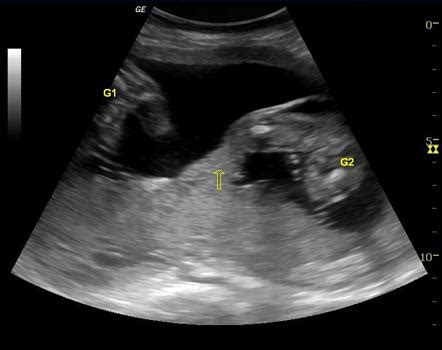 Twin pregnancy | Radiology Reference Article | Radiopaedia.org