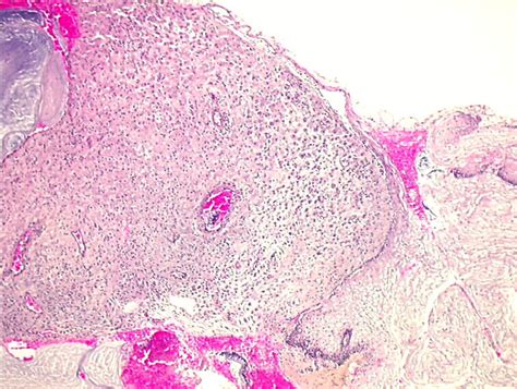 Pathology Outlines - Decidual reaction / ectopic decidua