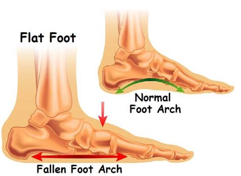 Most Likely Causes Of Pain In The Foot Arch Symptoms Treatments — Feet&Feet | atelier-yuwa.ciao.jp