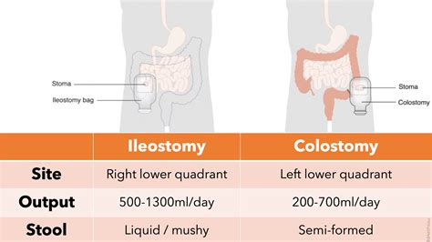 Ileostomy and Colostomy and 5 Nursing Diagnoses & Care Plans for ...