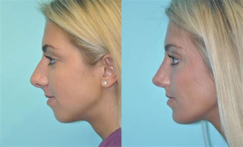 Chin & Facial Implant photos | Chevy Chase, MD | Patient 11614